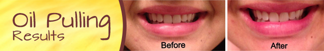 oil pulling before and after results